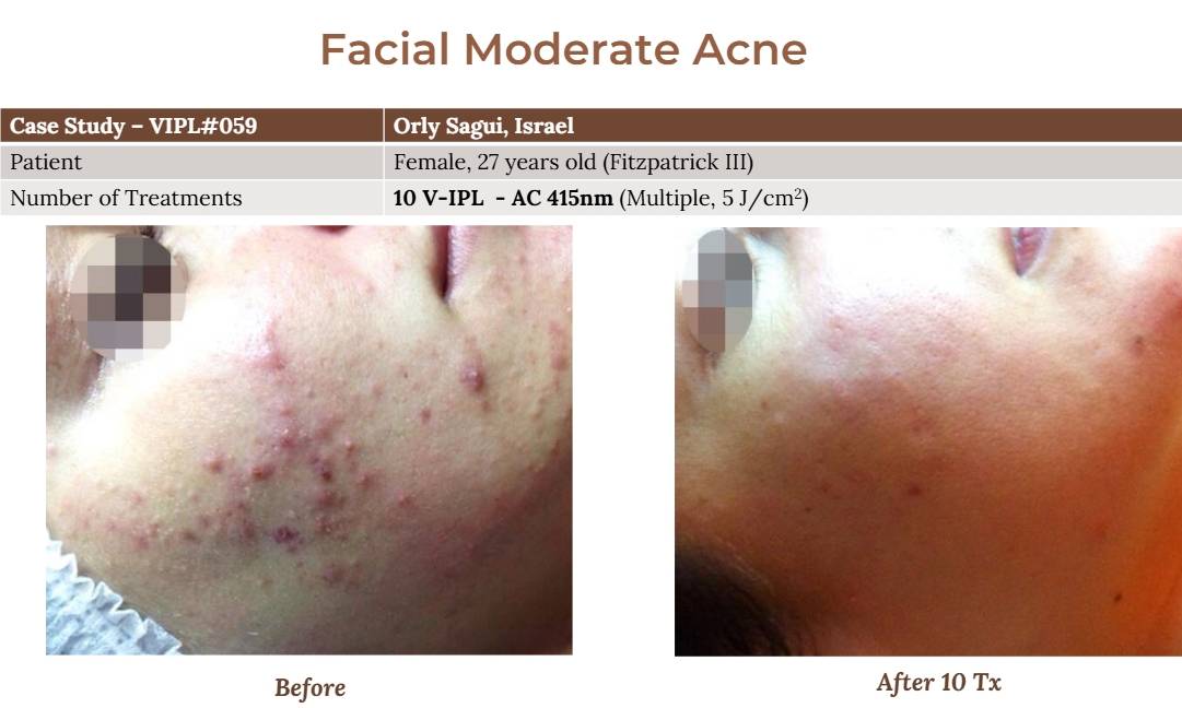 V-IPL case studies