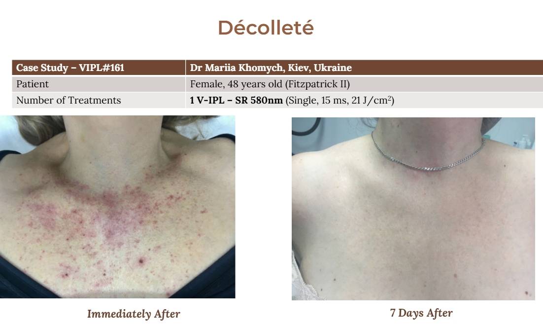 V-IPL case studies