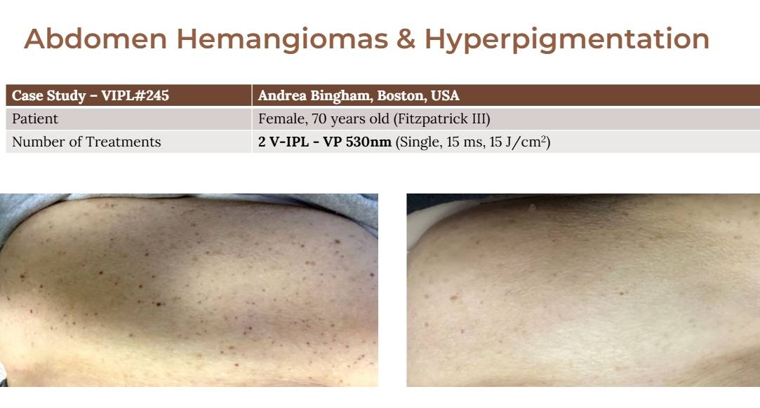 V-IPL case studies
