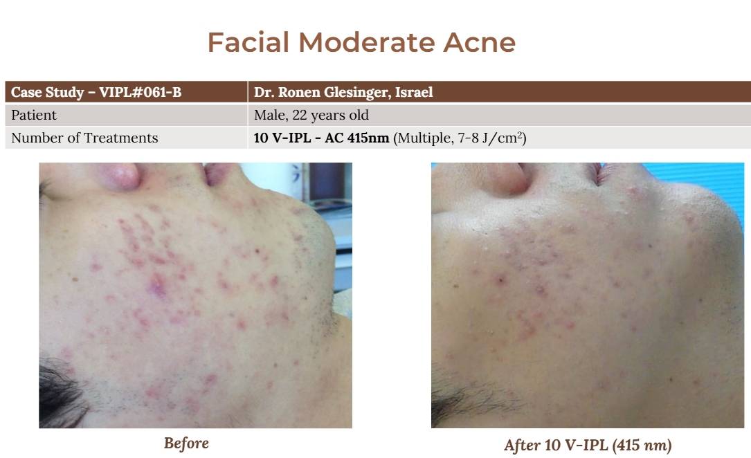V-IPL case studies