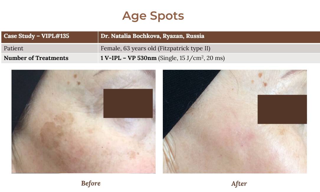 V-IPL case studies