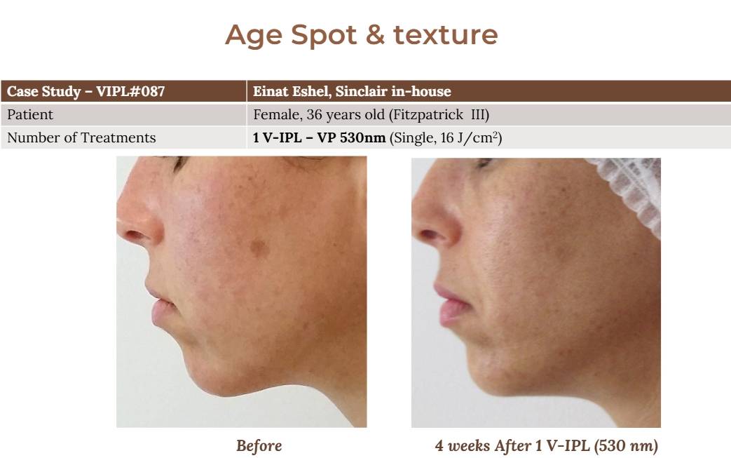 V-IPL case studies