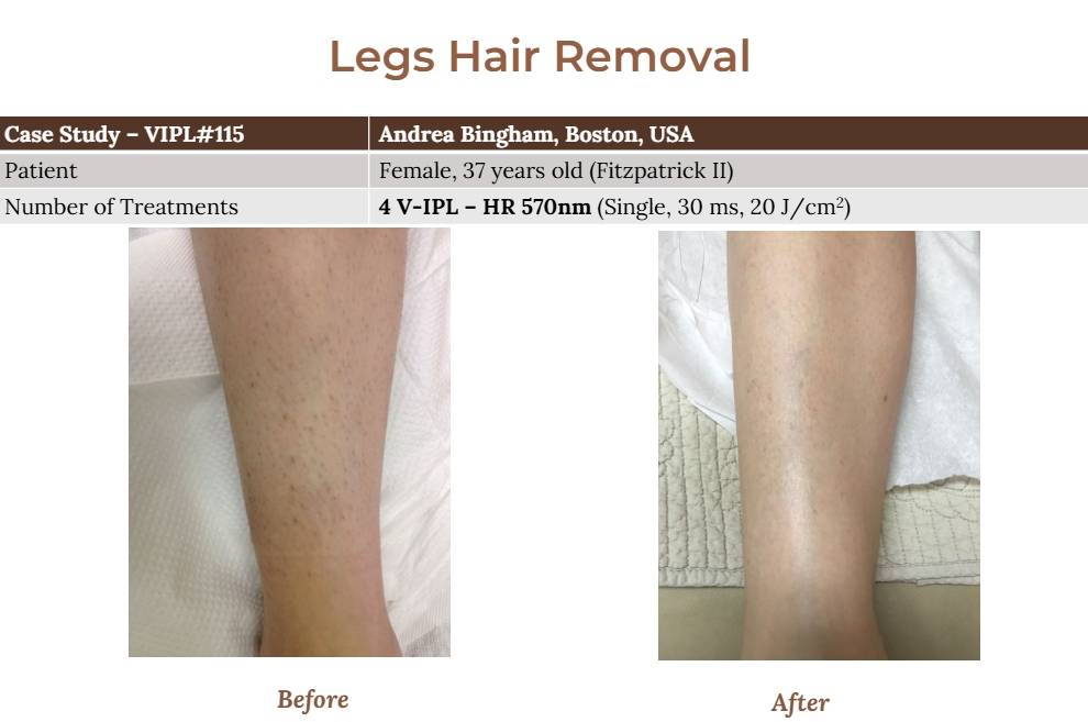 V-IPL case studies