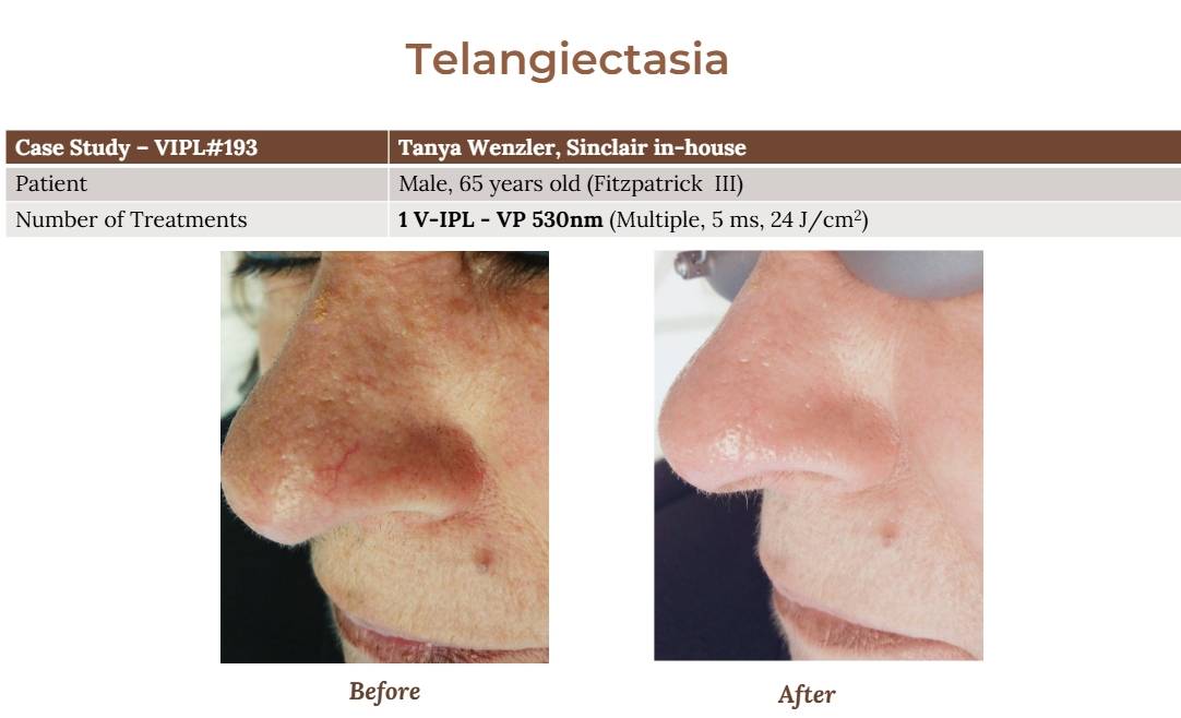 V-IPL case studies