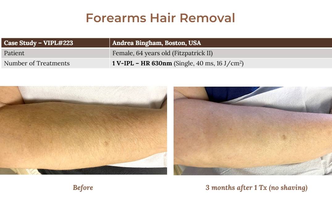 V-IPL case studies