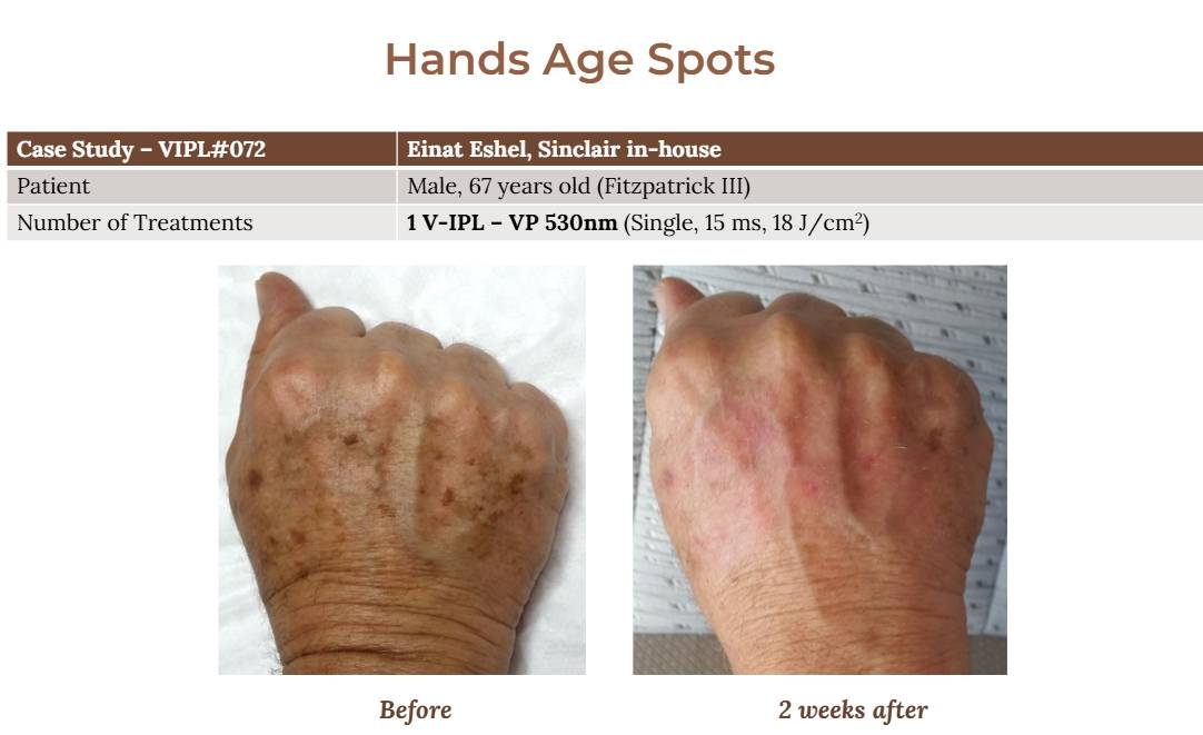 V-IPL case studies
