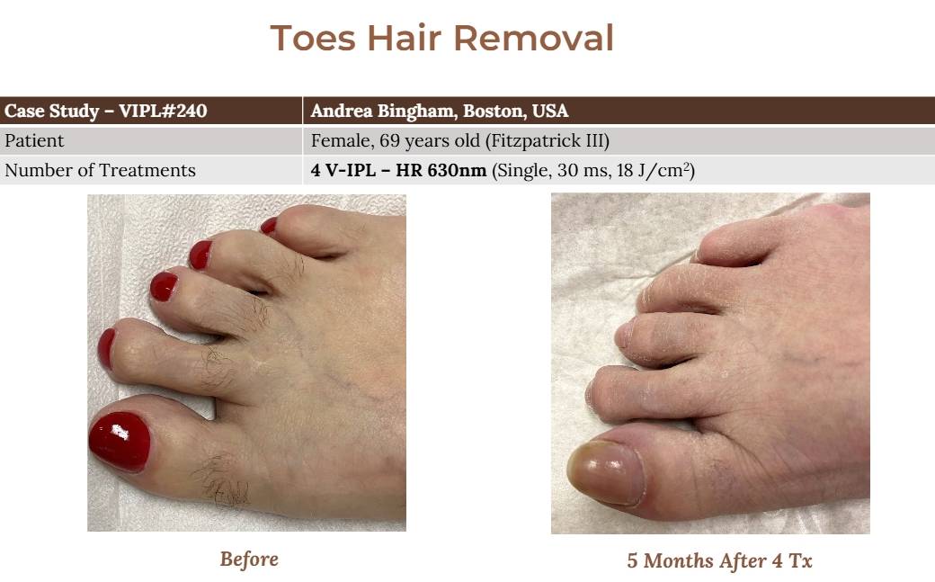 V-IPL case studies