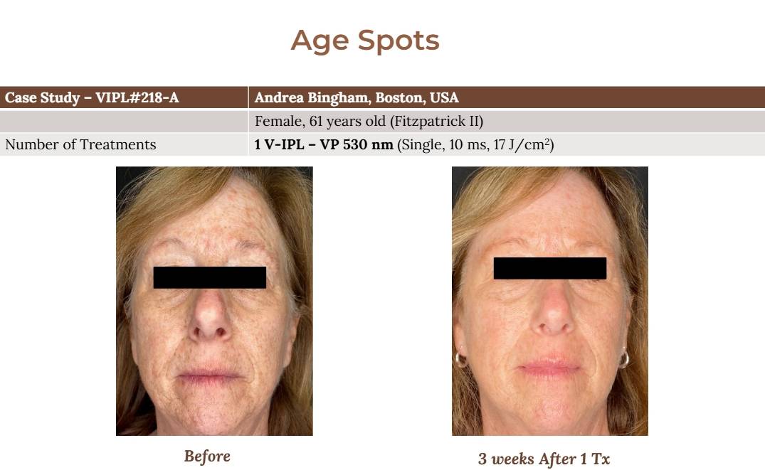 V-IPL case studies