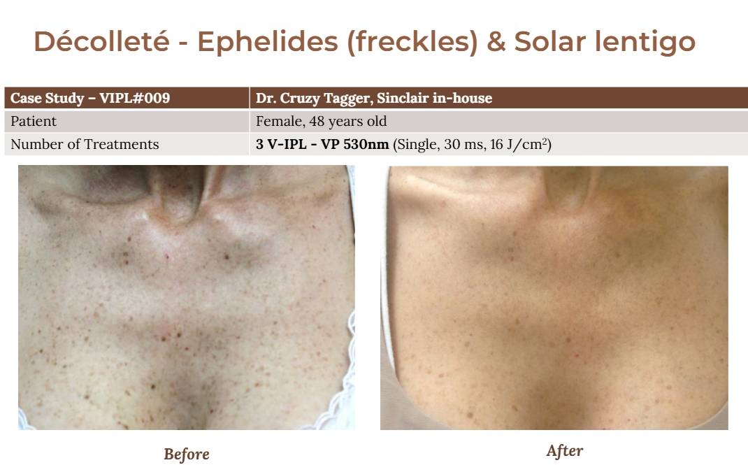 V-IPL case studies