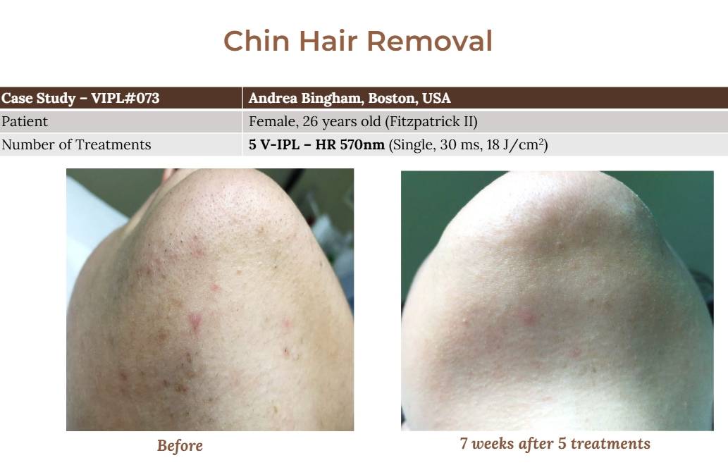 V-IPL case studies