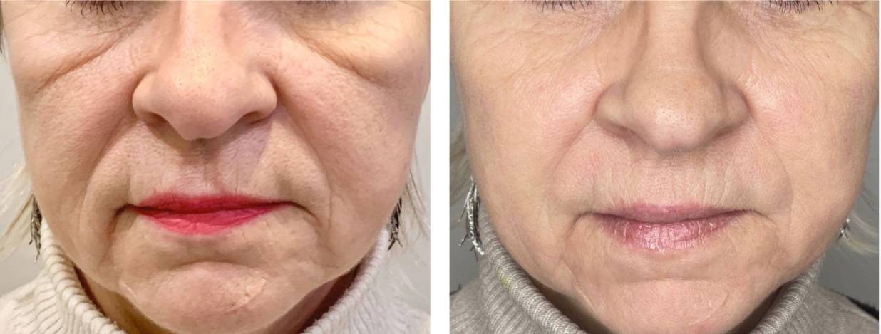 V-FR case studies