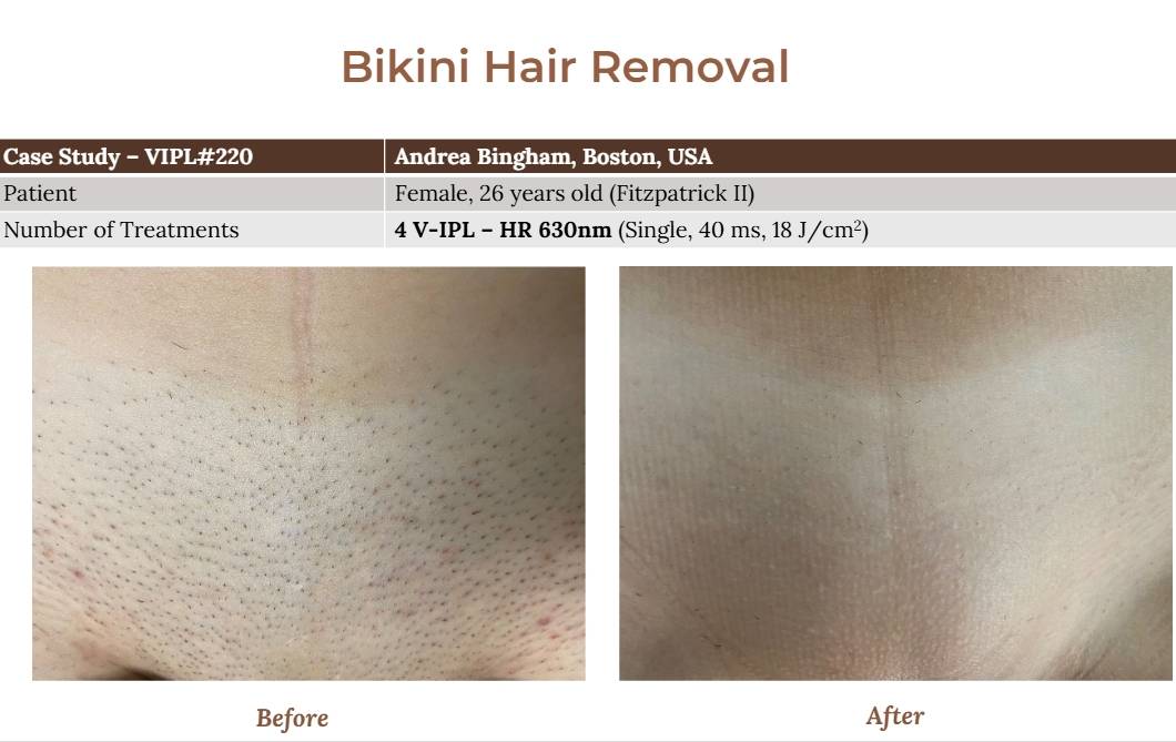 V-IPL case studies