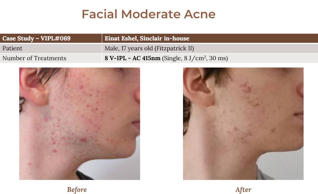 V-IPL case studies
