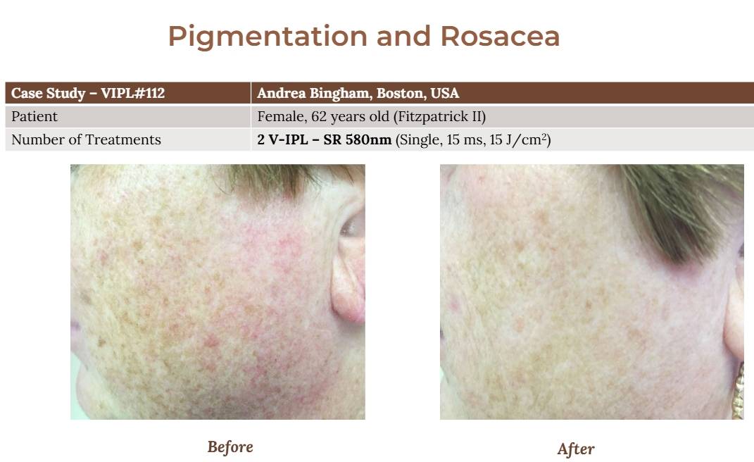 V-IPL case studies