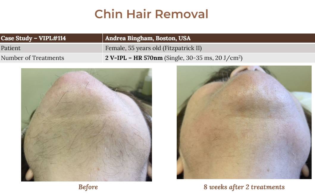 V-IPL case studies